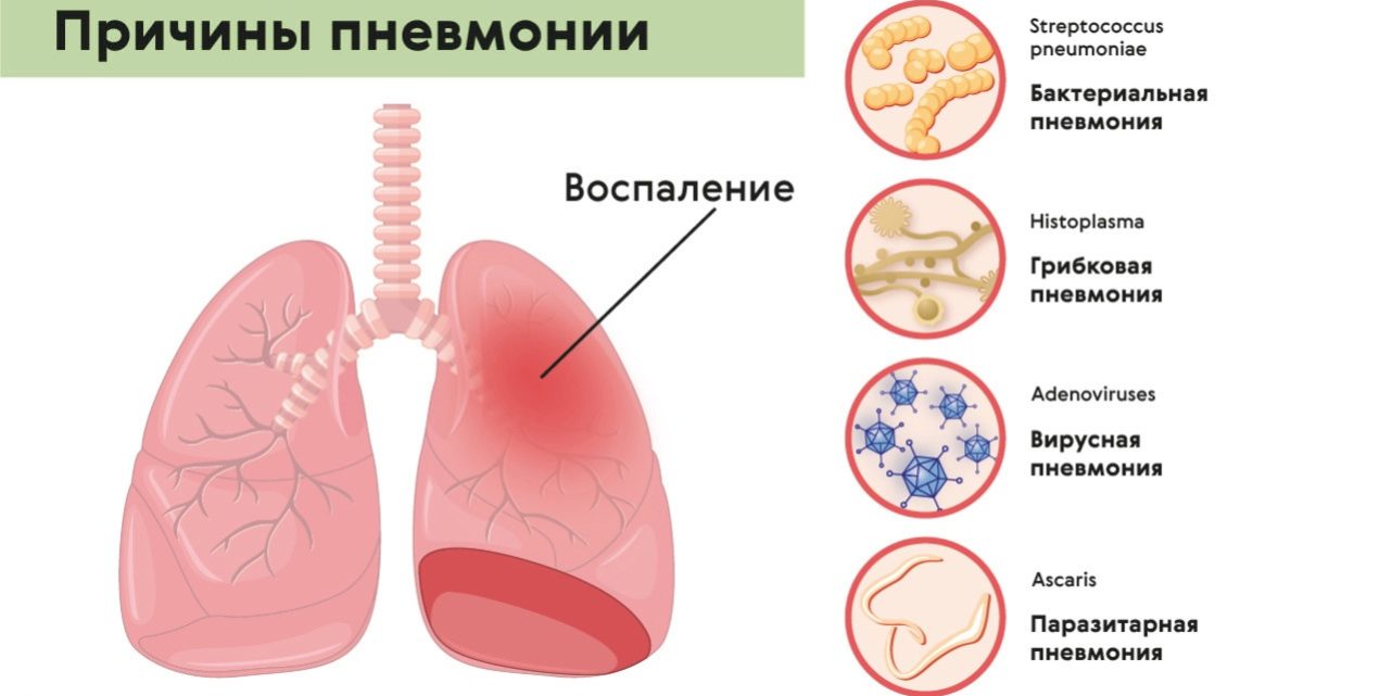 Причины пневмонии — БУ РК Республиканская больница им. П. П. Жемчуева