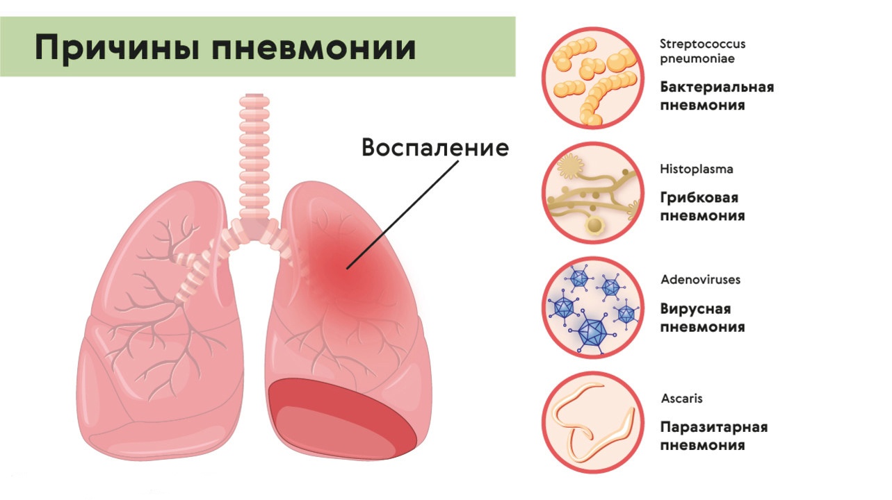 Пневмания легких лечится. Пневмония причины возникновения. Предпосылки пневмонии. Причины пневмонии. Факторы возникновения пневмонии.