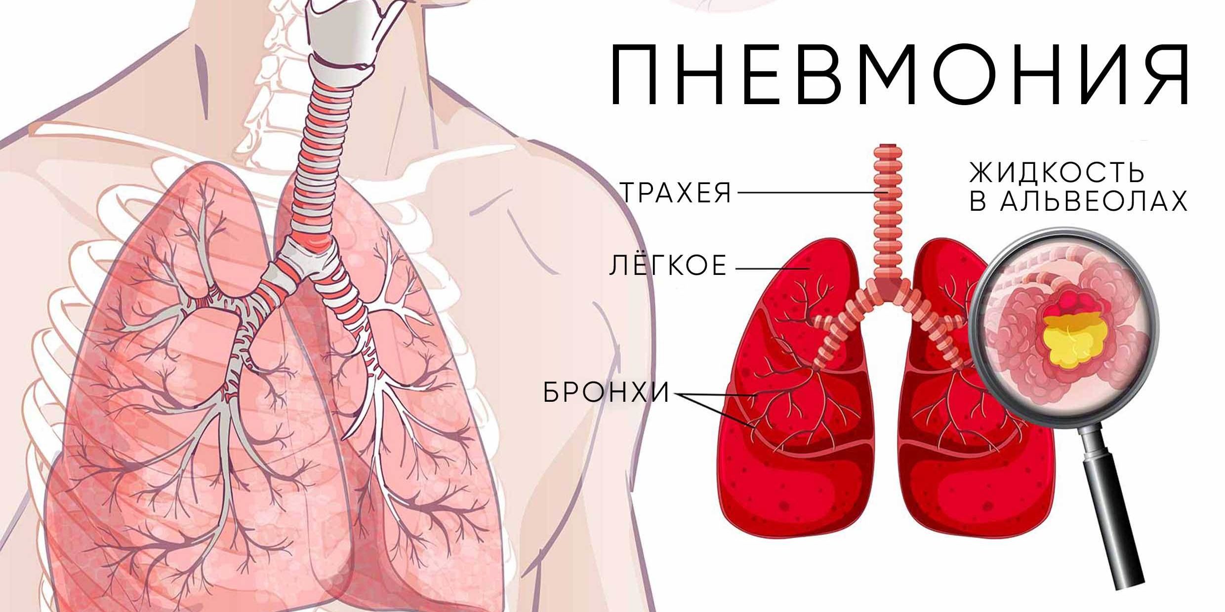 Симптомы пневмонии — БУ РК Республиканская больница им. П. П. Жемчуева