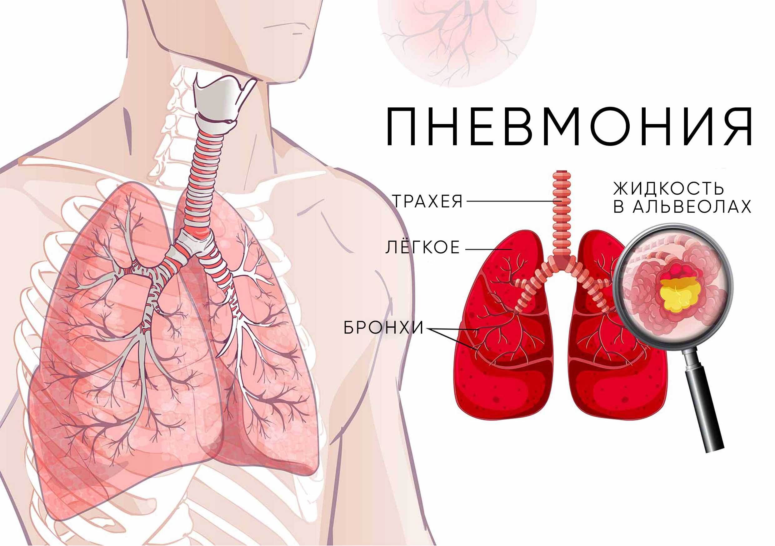 воспаление легких дома или в больнице (98) фото